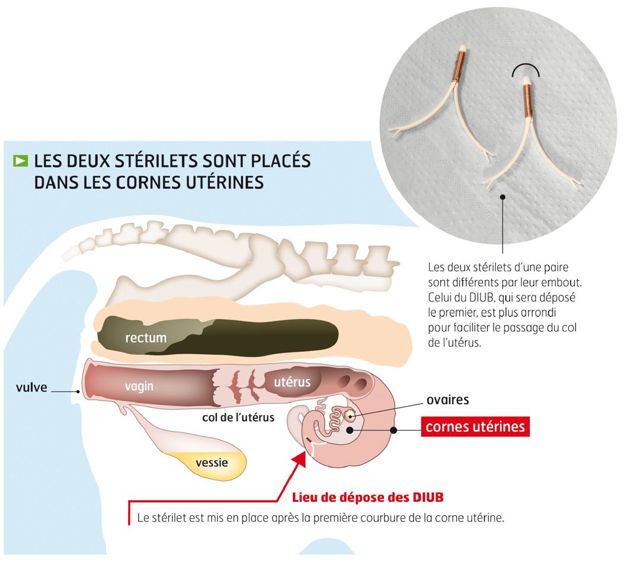 La mise en place du DIUB ressemble extérieurement à l'insémination à la différence près du pistolet, qui est légèrement plus gros. La mise en place du DIUB ressemble extérieurement à l'insémination à la différence près du pistolet, qui est légèrement plus gros.