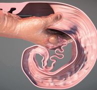 À l'aide d'un pistolet très innovant, la semence est déposée non plus à la sortie du col de l'utérus, mais 25 cm plus loin dans la corne utérine, à la jonction utérotubaire, là où les spermatozoïdes acquièrent leur pouvoir fécondant. À l'aide d'un pistolet très innovant, la semence est déposée non plus à la sortie du col de l'utérus, mais 25 cm plus loin dans la corne utérine, à la jonction utérotubaire, là où les spermatozoïdes acquièrent leur pouvoir fécondant.